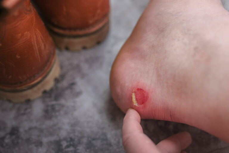 prevenir ampollas pies